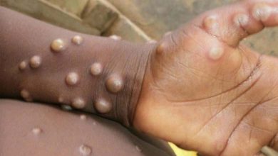 Le Continent africain - 1.715 cas de la variole du singe, 73 décès depuis le début de l'année