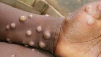 Le nombre de cas de variole de singe en Angleterre a atteint 225