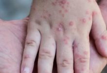 La variole du singe - Que faire en cas de symptômes ?