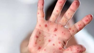 Variole du singe : premier décès officiellement lié à la maladie aux États-Unis