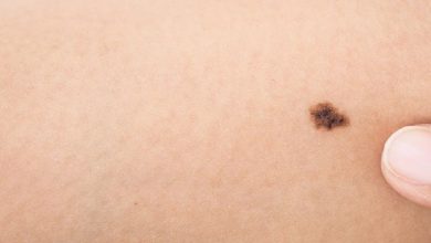 We all know how important it is to protect ourselves from the sun. But did you know there’s a new fad diet that could help prevent melanoma? The so-called ketogenic diet is low in carbs and high in healthy fats, and some experts believe it may help fight this type of cancer. If you’re looking for a way to lower your risk of melanoma, this diet might be of interest. Here’s what you need to know about the ketogenic diet and melanoma prevention.