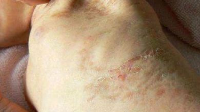 Incontinentia Pigmenti : symptômes, diagnostic, traitement de cette maladie génétique