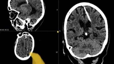 Des médecins russes découvrent une aiguille dans le cerveau d'une femme après 80 ans