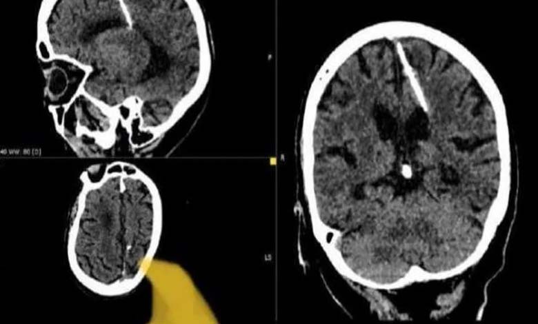 Des médecins russes découvrent une aiguille dans le cerveau d'une femme après 80 ans