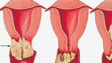5 raisons pour lesquelles les femmes peuvent contracter le cancer du col de l'utérus 