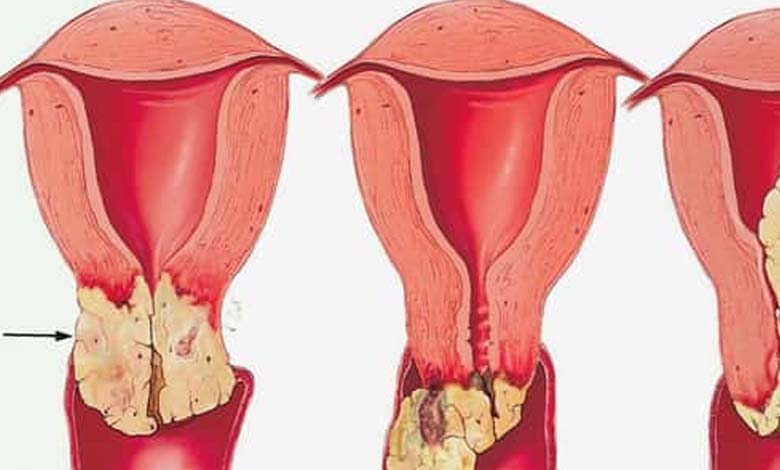 5 raisons pour lesquelles les femmes peuvent contracter le cancer du col de l'utérus 