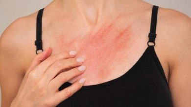 Propagation de la gale suscite l'inquiétude au Royaume-Uni 