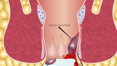 Un médecin révèle une surprise : les hémorroïdes pourraient être des symptômes du cancer