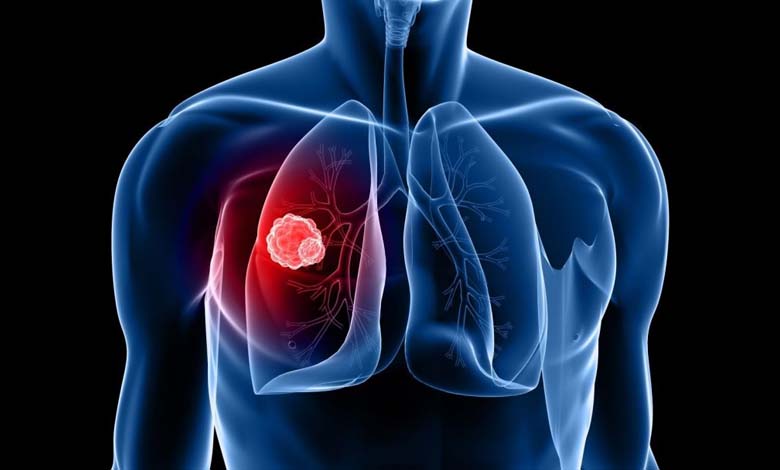 Une technologie prometteuse pour le dépistage précoce du cancer du poumon