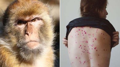 La Suède détecte le premier cas de variole du singe