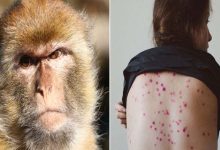 France Enregistre Son Premier Cas de Monkeypox