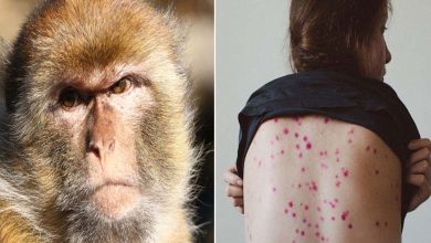 France Enregistre Son Premier Cas de Monkeypox