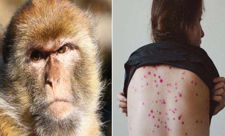 France Enregistre Son Premier Cas de Monkeypox