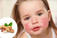 Un Nouveau Traitement pour l'Allergie aux Arachides chez les Enfants