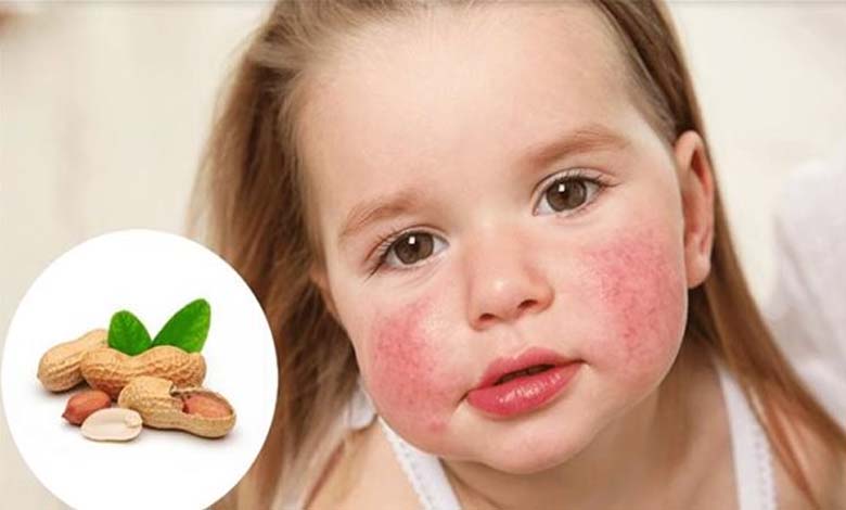 Un Nouveau Traitement pour l'Allergie aux Arachides chez les Enfants