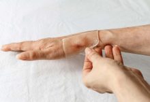 Le pansement en silicone est-il vraiment efficace pour traiter les cicatrices ?