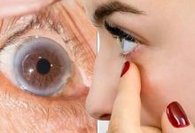 Les symptômes d’un taux élevé de cholestérol peuvent apparaître dans un seul œil