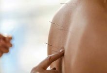L’acupuncture : un traitement efficace ou une simple illusion ?