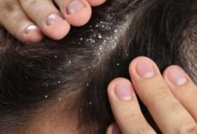 Comment le zinc aide-t-il à lutter contre les pellicules ?