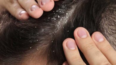 Comment le zinc aide-t-il à lutter contre les pellicules ?