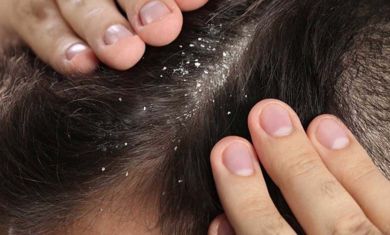 Comment le zinc aide-t-il à lutter contre les pellicules ?