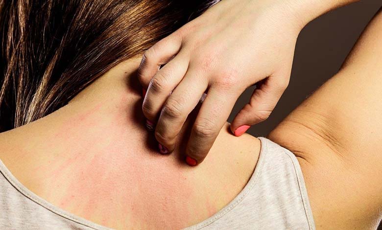 La démangeaison cutanée : un signal précoce possible d’une maladie rénale