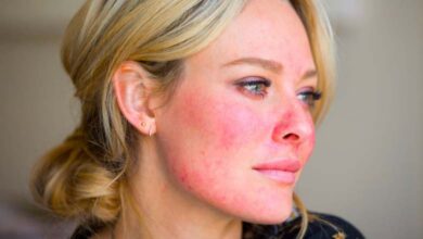 Pourquoi le visage devient-il plus rouge avec l’âge ?