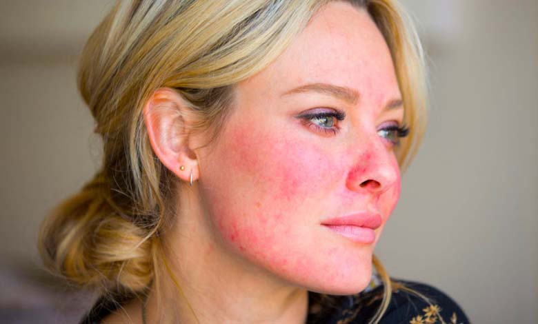 Pourquoi le visage devient-il plus rouge avec l’âge ?