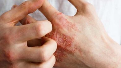 Étude : le stress psychologique aggrave l’eczéma