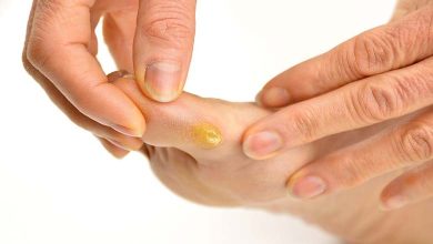 À l’approche de l’été, comment se débarrasser des callosités des pieds et prévenir leur réapparition ?