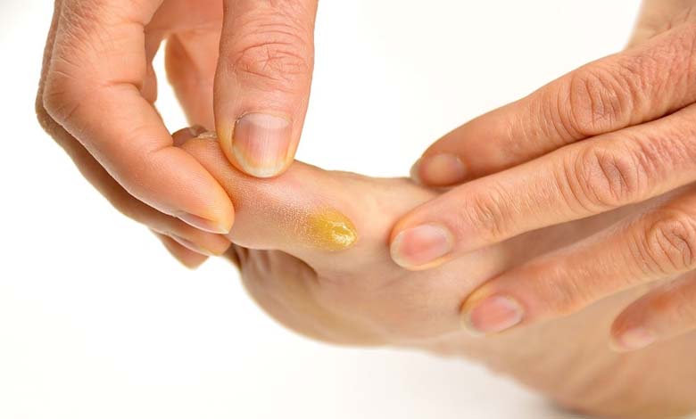 À l’approche de l’été, comment se débarrasser des callosités des pieds et prévenir leur réapparition ?