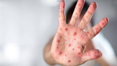 La rougeole suscite l’inquiétude après la hausse des cas aux États-Unis