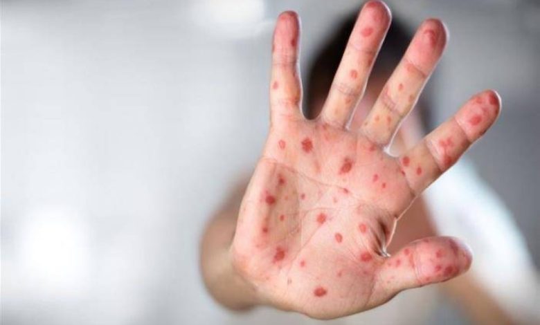 La rougeole suscite l’inquiétude après la hausse des cas aux États-Unis