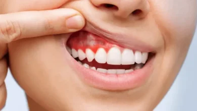 Le jeûne intermittent pourrait contribuer au traitement des maladies des gencives