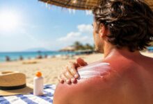 Étude alarmante : un seul coup de soleil peut-il favoriser le cancer ?