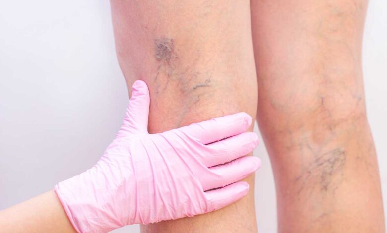Varices des jambes : les bons réflexes pour préserver sa circulation sanguine